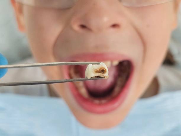 Best Same-Day Emergency Dentist in Santa Venetia, CA